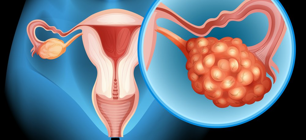 Uniogen develops test for ovarian cancer detection