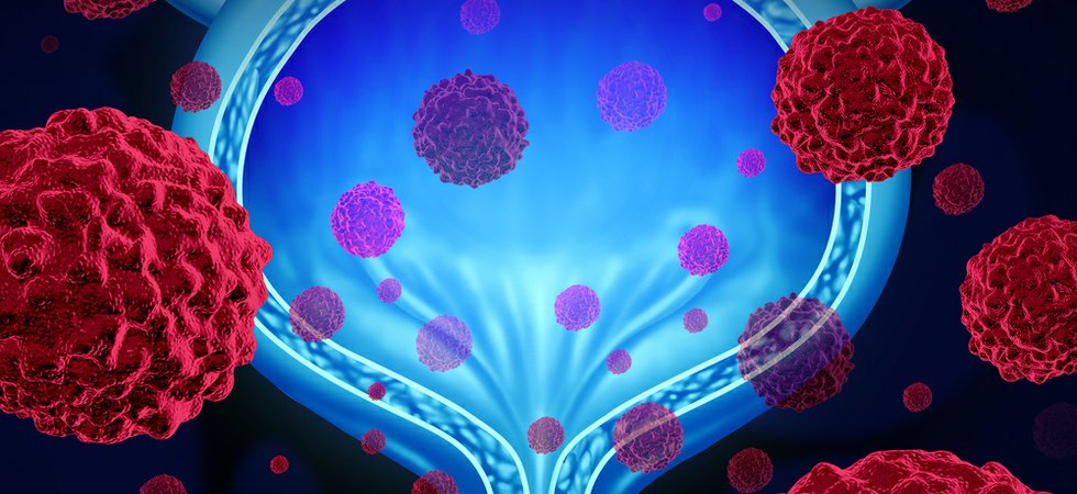Collaboration results in novel urine test to detect bladder cancer